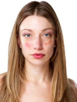 Skin Diseases